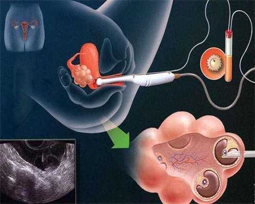 先天性卵巢发育不全能自然怀孕吗,借卵子试管婴